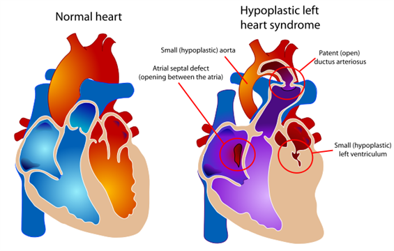 667px-Hypoplastic_left_heart_syndrome.svg