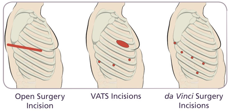 Incisions