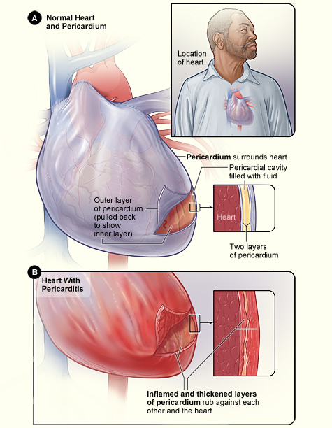 pericarditis