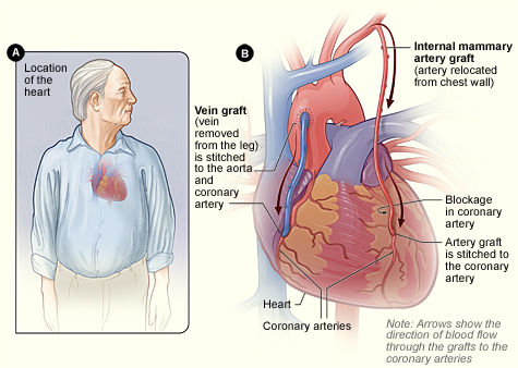 cabg